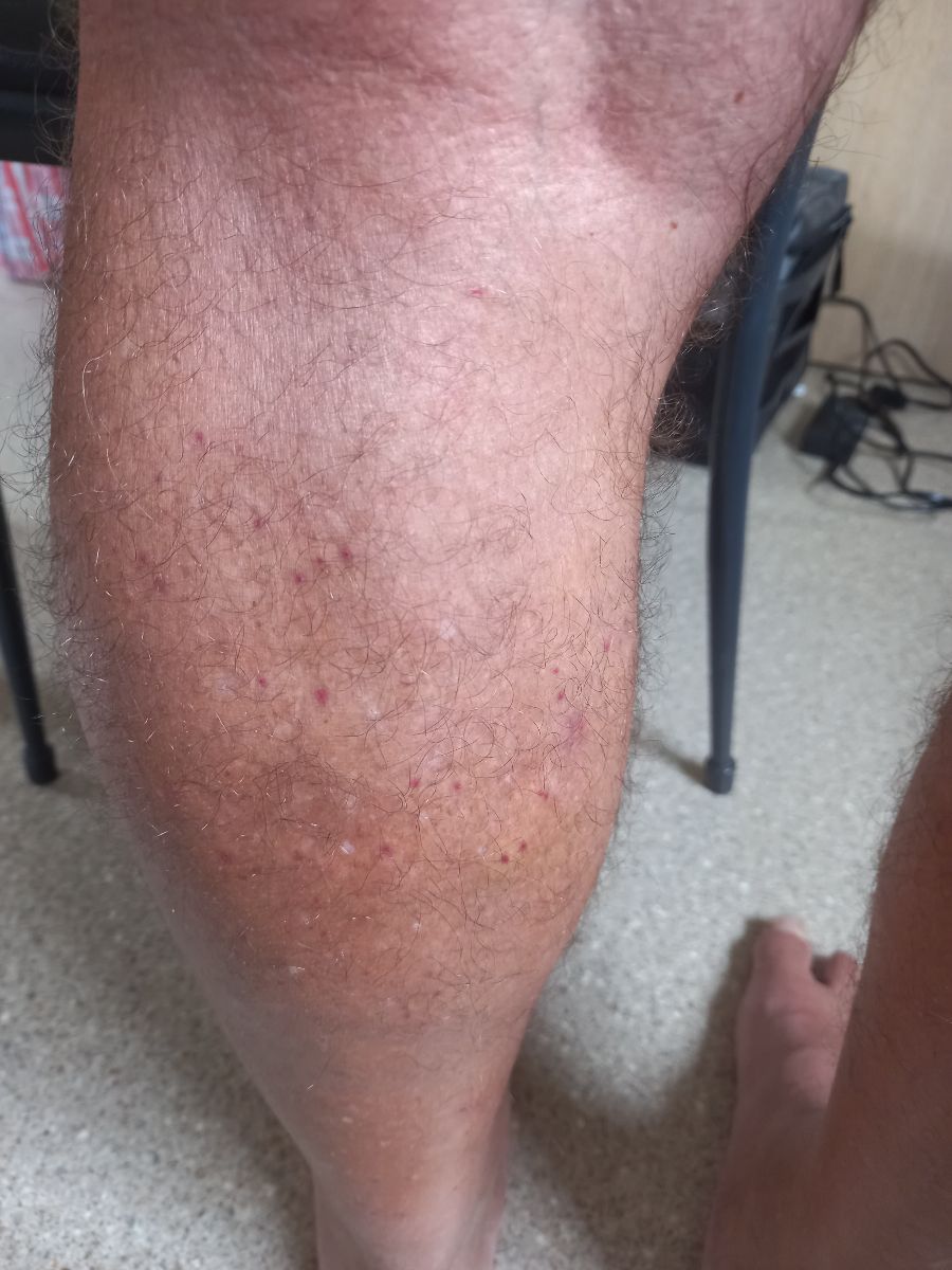 Sandfly bites all over!